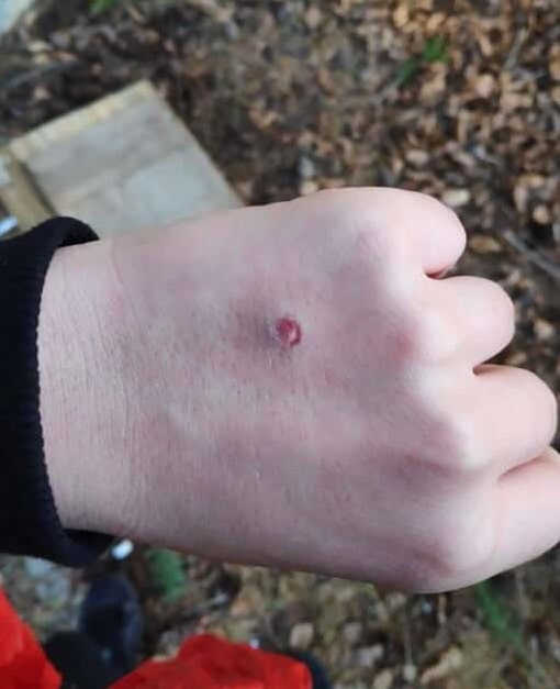 Airsoft Skin Injury bb 1